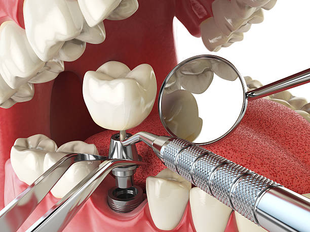 Best Emergency Dental Extractions in Iraan, TX