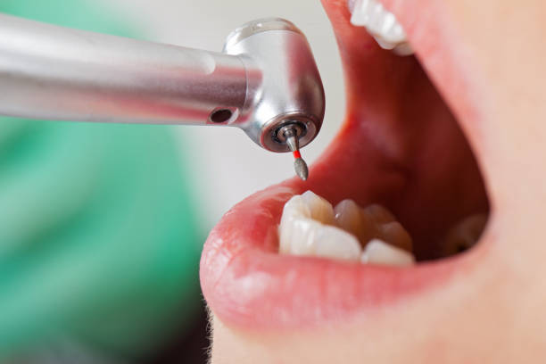 Best Emergency Dentist for Lost Fillings or Crowns in Iraan, TX